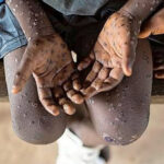 Ugonjwa wa Homa ya Nyani (Monkey pox)