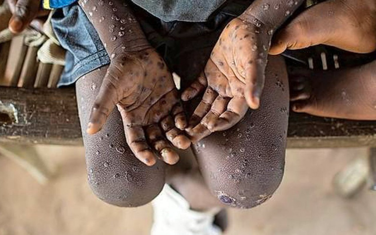 Ugonjwa wa Homa ya Nyani (Monkey pox)